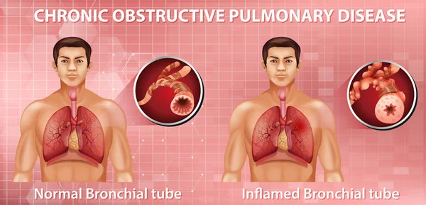说明慢性阻塞性肺病 — 图库矢量图片