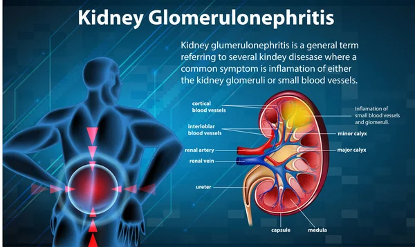 Infografía Médica Glomeruloesclerosis Renal Ilustración — Vector de stock