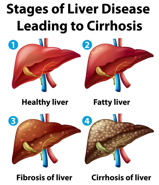 Májbetegség Cirrhosis Illusztrációhoz Vezető Stádiumai — Stock Vector