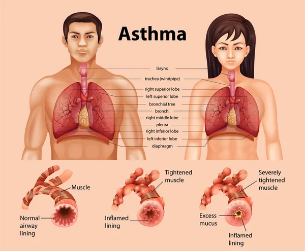 Comparação Pulmão Saudável Ilustração Pulmão Asmático — Vetor de Stock