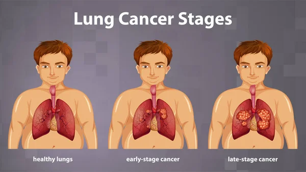 肺がんの病期図 — ストックベクタ
