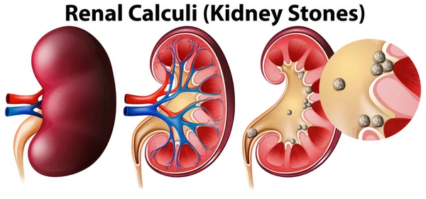 Anatomia Kamieni Nerkowych Nerkowych Ilustracja — Wektor stockowy