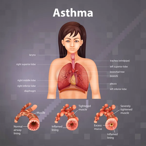 Comparação Pulmão Saudável Ilustração Pulmão Asmático — Vetor de Stock