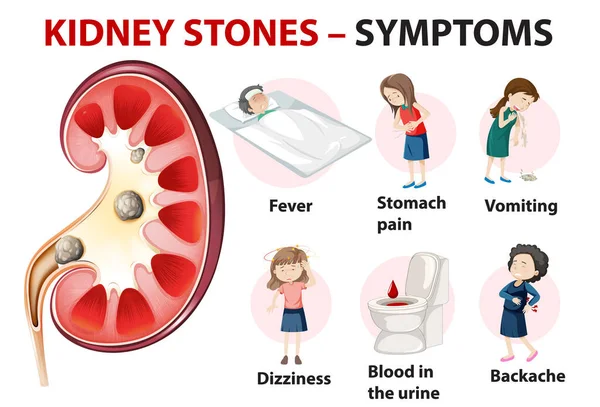 Nierensteine Symptome Cartoon Stil Infografik Illustration — Stockvektor