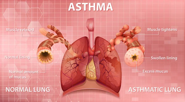 Egészséges Tüdő Asztmás Tüdőillusztráció Összehasonlítása — Stock Vector