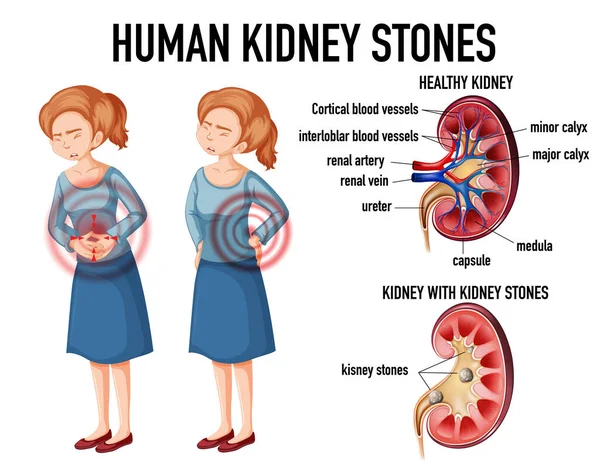 Comparación Riñón Sano Riñón Con Cálculos Ilustración — Vector de stock