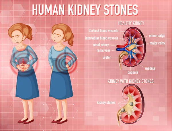 Porovnání Zdravé Ledviny Ledvin Kamennou Ilustrací — Stockový vektor