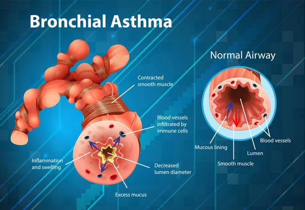 Illustration Tube Bronchique Enflammé Par Asthme — Image vectorielle