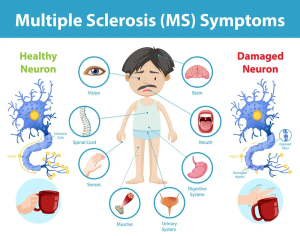 Esclerosis Múltiple Síntomas Información Ilustración Infográfica — Vector de stock