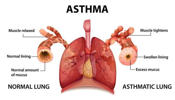 Nsan Anatomisi Astım Diyagramı Çizimi — Stok Vektör