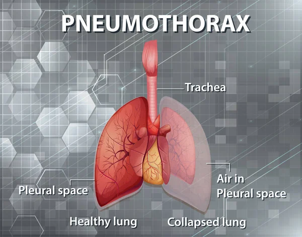 Ilustração Informativa Ilustração Pneumotórax — Vetor de Stock