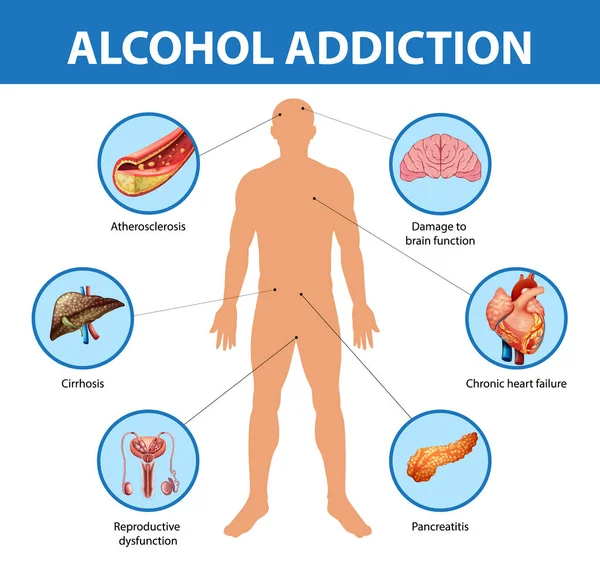 アルコール中毒やアルコール依存症の情報インフォグラフィックイラスト — ストックベクタ
