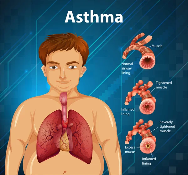 Emberi Anatómia Asztma Diagram Illusztráció — Stock Vector