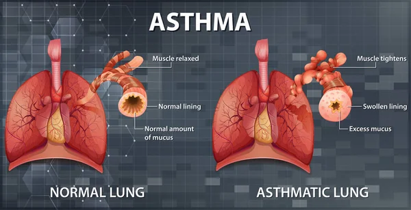 Comparaison Des Poumons Sains Des Poumons Asthmatiques Illustration — Image vectorielle