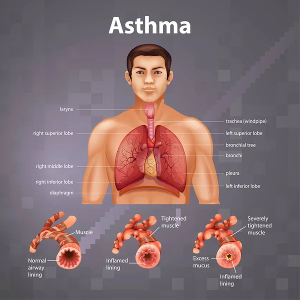 Ludzka Anatomia Schemat Astmy Ilustracja — Wektor stockowy