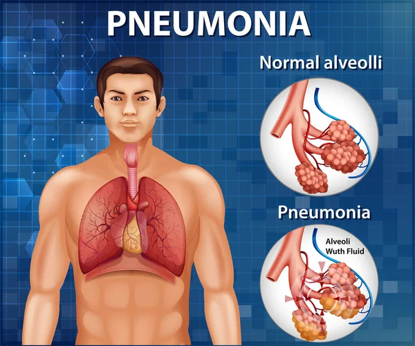 Сравнение Здоровых Альвеол Пневмонии — стоковый вектор