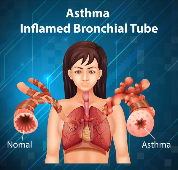 Mänsklig Anatomi Astma Inflammerad Bronkial Tube Diagram Illustration — Stock vektor