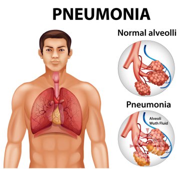 Sağlıklı alveoller ve zatürree örneklerinin karşılaştırılması