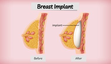 İnsan göğüs implantı örnekleme anatomisi