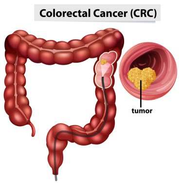 Colorectal Cancer (CRC) infographic for education illustration clipart