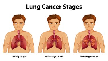 Akciğer kanseri illüstrasyonunun aydınlatıcı gösterimi