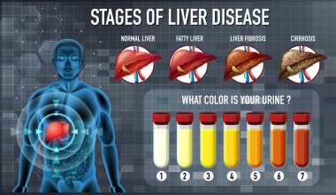 Stages of liver disease illustration clipart