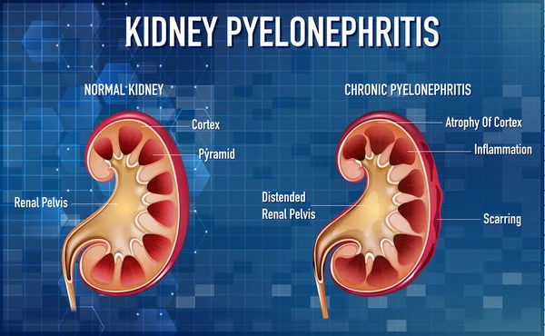 Informativ Illustration Pyelonefrit Illustration — Stock vektor