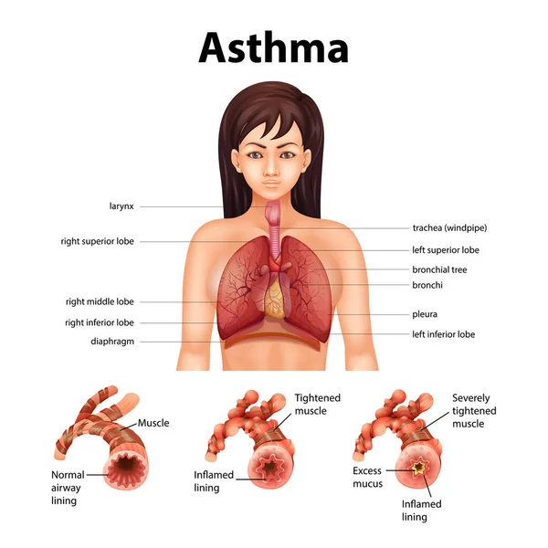 Comparação Pulmão Saudável Ilustração Pulmão Asmático — Vetor de Stock