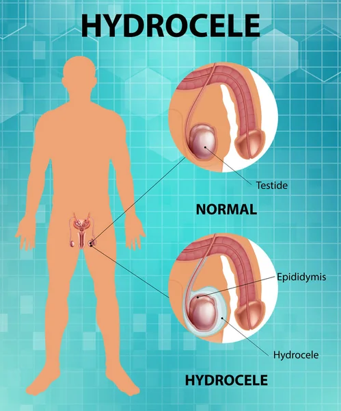 Medical Poster Showing Different Male Normal Testicle Hydrocele Illustration — Stockvector