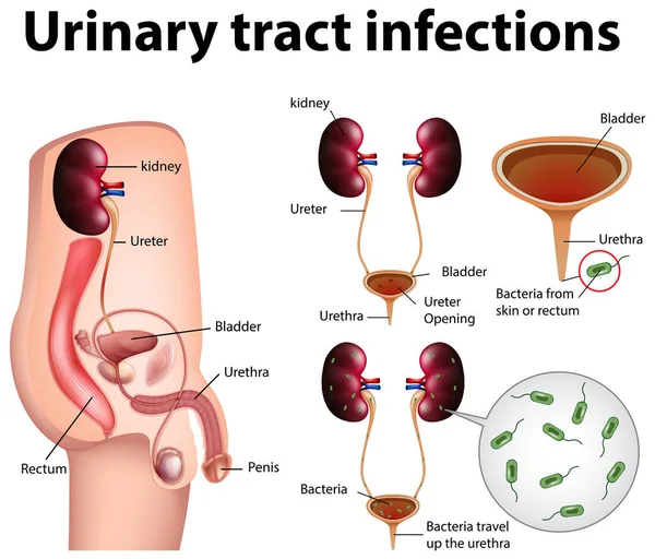 Ilustración Informativa Infecciones Del Tracto Urinario Ilustración — Vector de stock