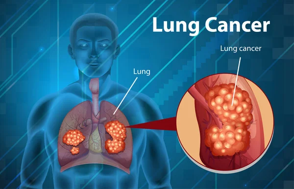 Illustration Instructive Illustration Cancer Poumon — Image vectorielle