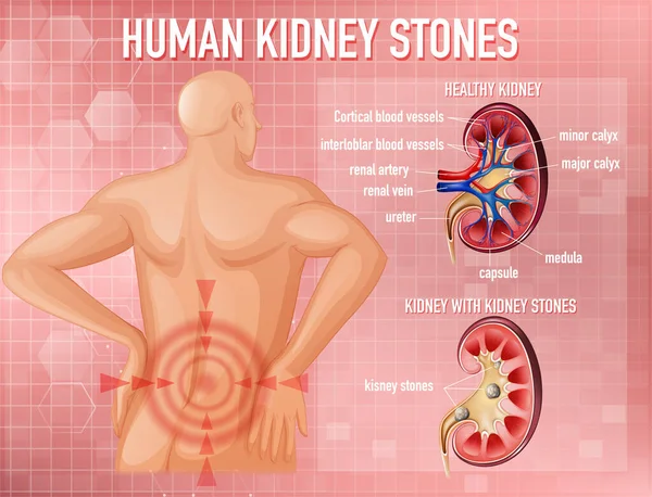 Informative Illustration Der Nierensteine Illustration — Stockvektor