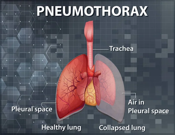 Illustration Informative Pneumothorax — Image vectorielle