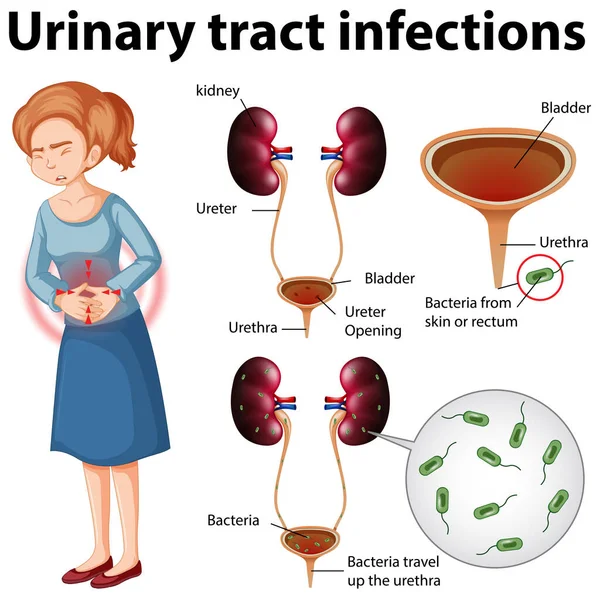 Informativ Illustration Urinvägsinfektioner Illustration — Stock vektor