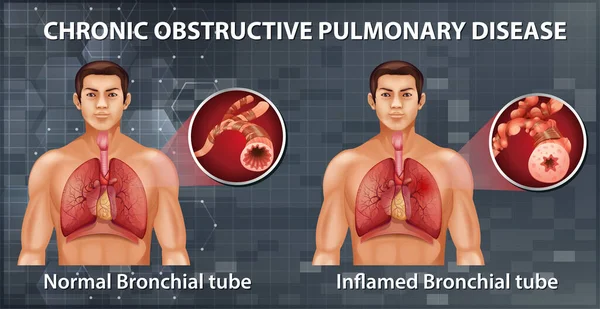 慢性閉塞性肺疾患のイラスト — ストックベクタ
