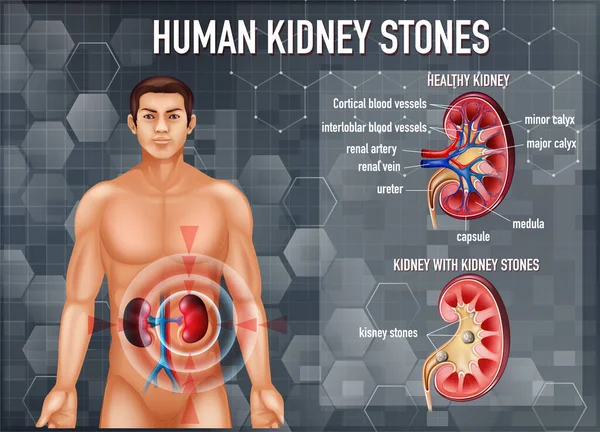 健康肾与肾结石的比较 — 图库矢量图片