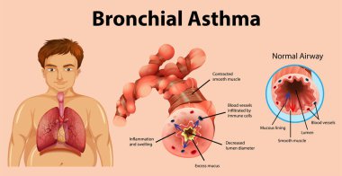 Astım iltihaplı bronş tüpü çizimi