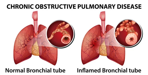 Illustration Des Maladies Pulmonaires Obstructives Chroniques — Image vectorielle