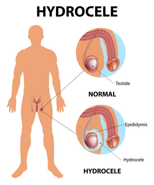 Medical poster showing different between male normal testicle and hydrocele illustration