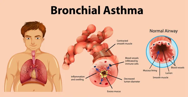 Illustration Tube Bronchique Enflammé Par Asthme — Image vectorielle