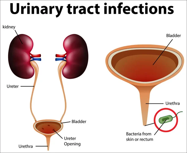 Ilustración Informativa Infecciones Del Tracto Urinario Ilustración — Vector de stock