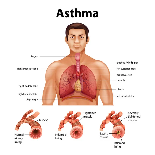 Comparação Pulmão Saudável Ilustração Pulmão Asmático — Vetor de Stock