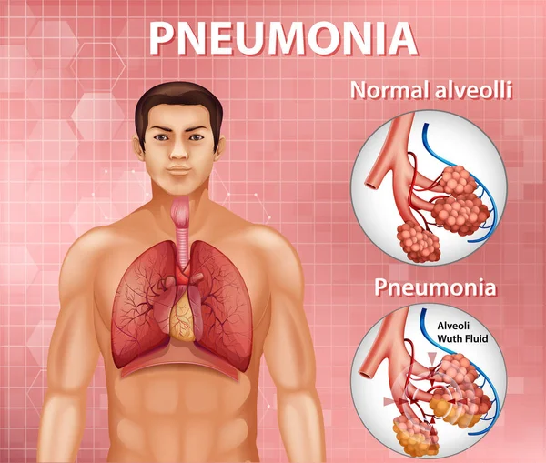 Comparação Alvéolos Saudáveis Ilustração Pneumonia — Vetor de Stock