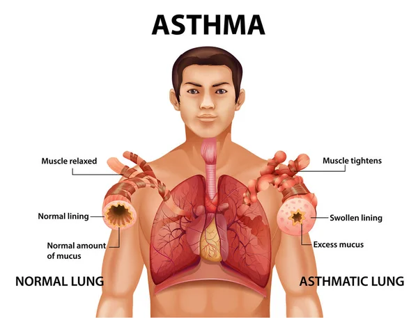 Sağlıklı Akciğer Astım Illüstrasyonu Karşılaştırması — Stok Vektör