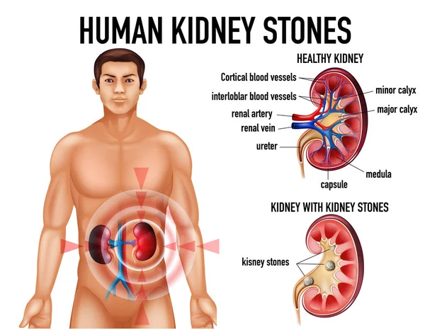 健康な腎臓と石のイラストとの比較 — ストックベクタ