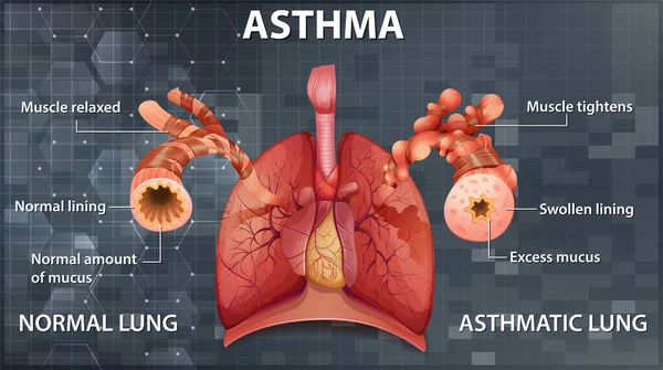 Jämförelse Friska Lunga Och Astmatisk Lunga Illustration — Stock vektor