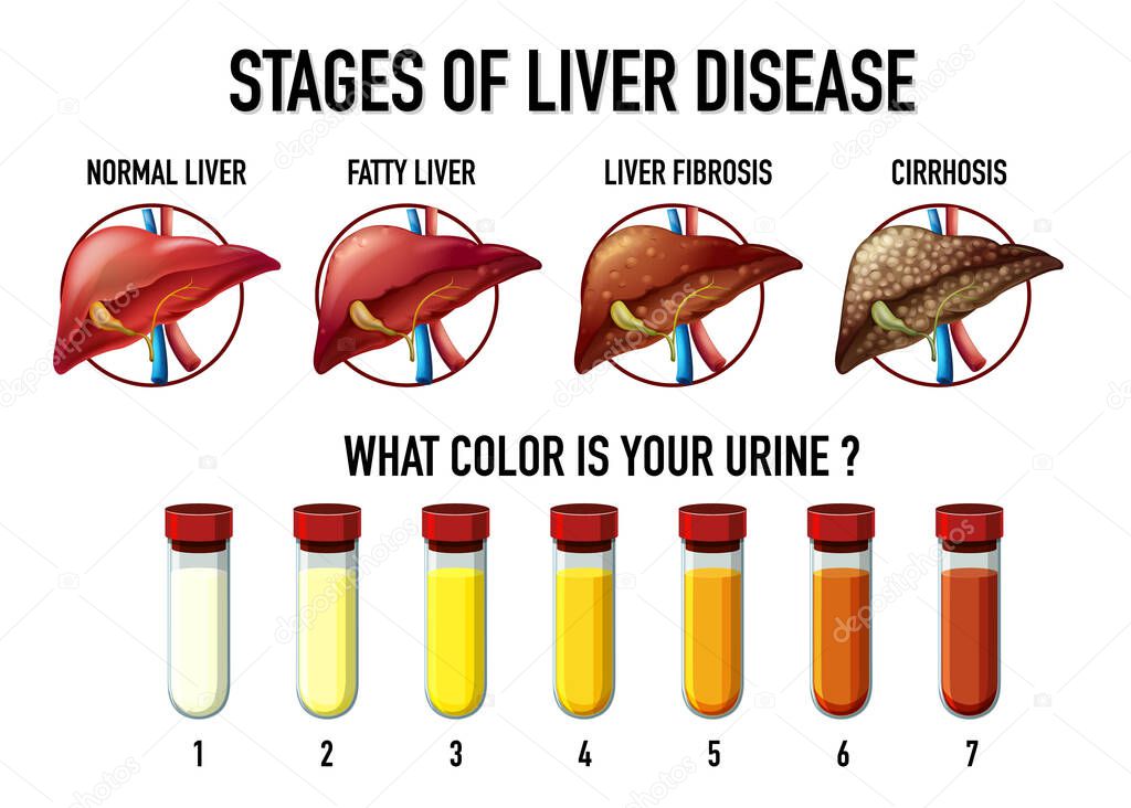 Stages of liver disease illustration