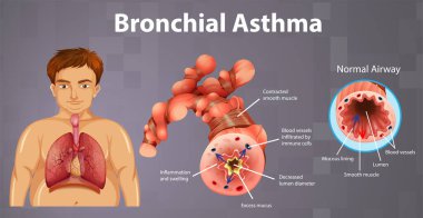 Astım iltihaplı bronş tüpü çizimi
