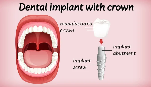 Implant Stomatologiczny Ilustracją Korony — Wektor stockowy