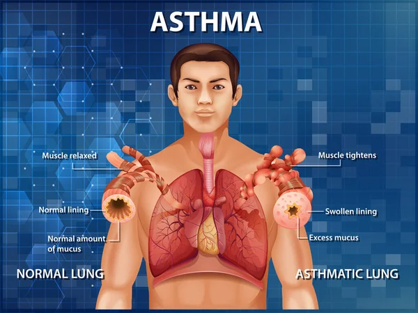 Anatomía Humana Ilustración Del Diagrama Del Asma — Vector de stock